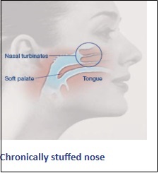 chronically-stuffed-nose2