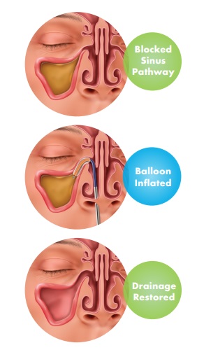 how-dilation-works