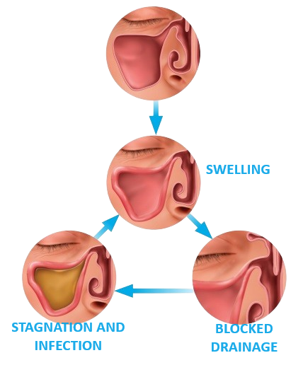 sinusitis-diagram